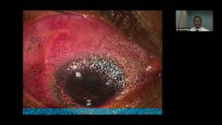 Lecture Scleral and Corneal Inflammatory Disorders [upl. by Nosyerg680]