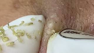 Acne treatment for Spa Linh Mun 2023 075 [upl. by Imij]