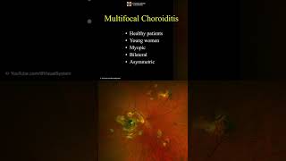 Multifocal Choroiditis ophthalmology optometry [upl. by Oad95]