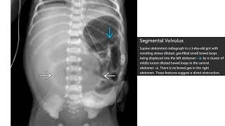 Segmental Volvulus Imaging [upl. by Nitaf]