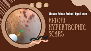 Vbeam Prima Pulsed Dye Laser  Keloid Hypertrophic Scars  West Hollywood CA  Dr Jason Emer [upl. by Squires]