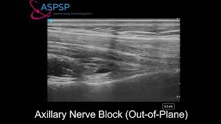 Ultrasound Guided Axillary Nerve Block Out of Plane Approach [upl. by Aldon]