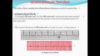 Principles of ECG quotelectrocardiographyquot Part 11 [upl. by Hartmann403]