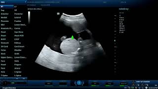 Achondroplasia associated with Hydrocephalus  Diagnostic ultrasound cases [upl. by Mutat838]