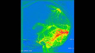 Angiography of the brain [upl. by Ennayhc174]