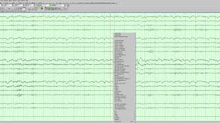 Left temporal epileptiform activity [upl. by Meier]