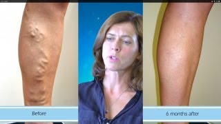 Amazing Results from Varicose Vein Surgery [upl. by Gilbert]