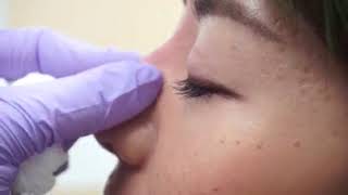 Non Surgical Rhinoplasty with Dr Onir [upl. by Skardol142]