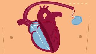 SchrittmacherImplantation am Universitätsspital Basel [upl. by Mame]