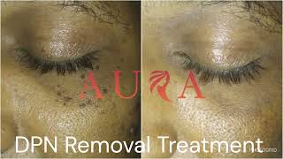 DPN Removal  Dr Nidheesh Agarwal  Aura Skin And Hair Clinic [upl. by Marozik]