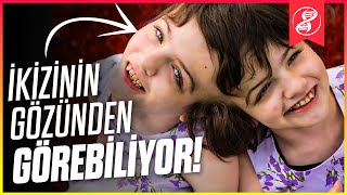 Yapışık İkizler Birbirlerinin Düşüncelerini Okuyabilir mi [upl. by Crenshaw]