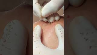 Best Pimple Popping 21 beautiful blackheads sacdepspa reels cute facts best [upl. by Ellehsem591]