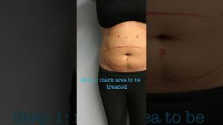 Full CoolSculpting Treatment with Before and Afters [upl. by Keeryt]