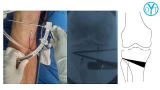 Osteotomía tibial proximal osteotomía Monoplanar vs Biplanar [upl. by Nanaek]