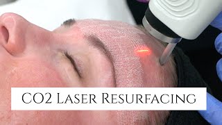 CO2 Laser Facial Rejuvenation  Fix Fine Lines and Wrinkles  Fix Sun Damage  Fix Stretch Marks [upl. by Ilbert]