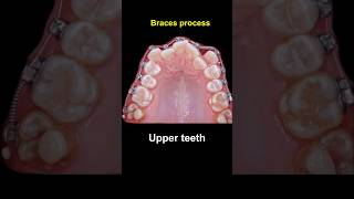 Braces duration  28 months braces orthodontist bracesoff dentist [upl. by Arodasi]