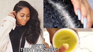 How to Treat Dandruff Dry Scalp amp Psoriasis Naturally at Home‼️ [upl. by Butterworth]