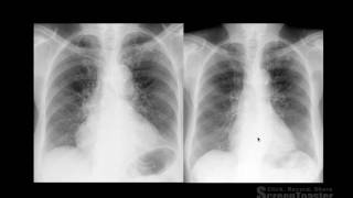 Thorax  Semiologia Radiológica do Tórax  PARTE 1 [upl. by Nairrad]