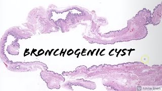 Bronchogenic Cyst 5Minute Pathology Pearls [upl. by Bethina]