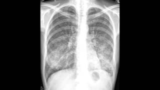 Interstitial Pneumonia Atypical  Organisms amp Characteristics [upl. by Renado69]