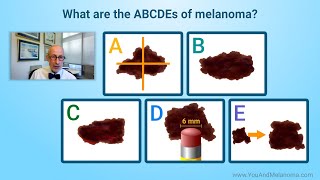 What are the signs and symptoms of melanoma [upl. by Ahsinehs]