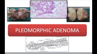 Pleomorphic Adenoma [upl. by Nautna813]