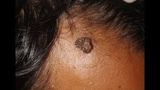 Wart removal  Dr Amit Mohan [upl. by Herrera]