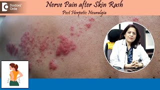 NERVE PAIN AFTER SKIN RASH Post Herpetic Neuralgia  Herpes ZosterDrSwati Bhat  Doctors Circle [upl. by Hsivat956]