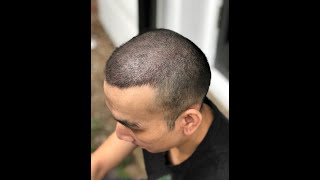 Combining SMP with an FUE Hair Transplant Hair Loss TattooScalp Micropigmentation [upl. by Adnarym]