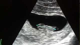 Identical Twins แฝดแท้ Ultrasound อายุ 8 สัปดาห์ 4 วัน [upl. by Sinnod]