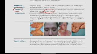 Polymyositis  Dermatomyositis  Musculoskeletal  28  First Aid USMLE in UrduHindi [upl. by Ahsito757]