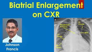 Biatrial Enlargement on CXR [upl. by Deden184]