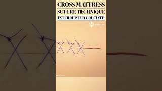 Cross Mattress Suture Technique aka Cruciate shorts education training suture medical surgeon [upl. by Davy36]