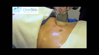 VelaShape Treatment for Cellulite at ClearSkin [upl. by Ellocin910]