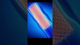 3D Animation of Angioplasty Heart Procedure Medical Animation Explained [upl. by Ekusoyr416]