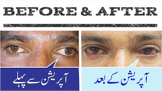 Squint Correction surgery  Before and After  in Urdu Hindi [upl. by Oinotna]