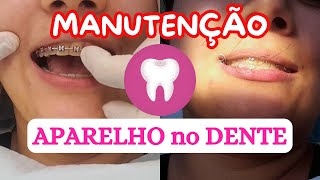 MANUTENÇÃO NO DENTISTA  ATUALIZAÇÃO DO APARELHO PARTE 4 dentista dentes aparelhoortodôntico [upl. by Silvie]