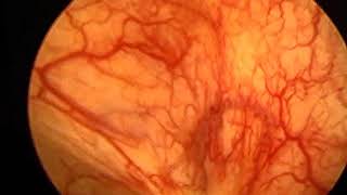 Endoscopic view of interstitial cystitis bladder during low pressure cystoscopy [upl. by Aknaib472]