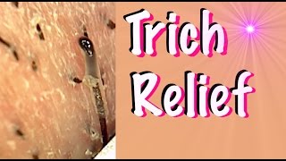 Trich Relief Video  Help for Trichotillomania [upl. by Sirret]