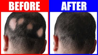 Reversing Alopecia The Power Of 3 Trace Minerals [upl. by Arela]