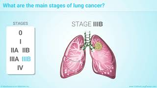 Staging of Lung Cancer [upl. by Omixam909]