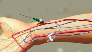 Animation of Transradial intervention [upl. by Nagiem841]