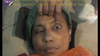 PERIBULBAR BLOCK  Cataract Surgery  DrSamar Basak [upl. by Eloci]