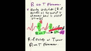 Ventricular ectopyescape and accelerated idioventicular rhythm [upl. by Zennie]