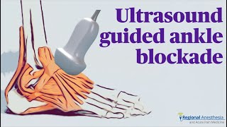 Ultrasound Guided Ankle Block [upl. by Enahpets103]