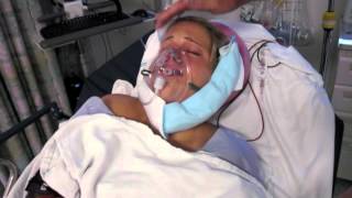 Underbite Jaw Surgery video 11 SURGERY DAY pre and postop [upl. by Mall]