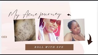 How i cleared my acne pimples and dark spotsMY ACNE JOURNEY part 2 [upl. by Innus264]