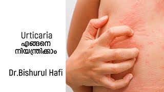 Urticaria എങ്ങനെ നിയന്ത്രിക്കാം  Malayalam Skin care  Dr Bishurul Hari [upl. by Borgeson]