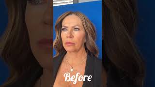 Facelift Surgery [upl. by Obellia]