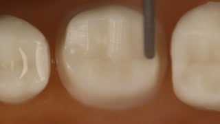 PFM Crown Posterior Tooth Preparation With Metal Occlusal [upl. by Marji670]